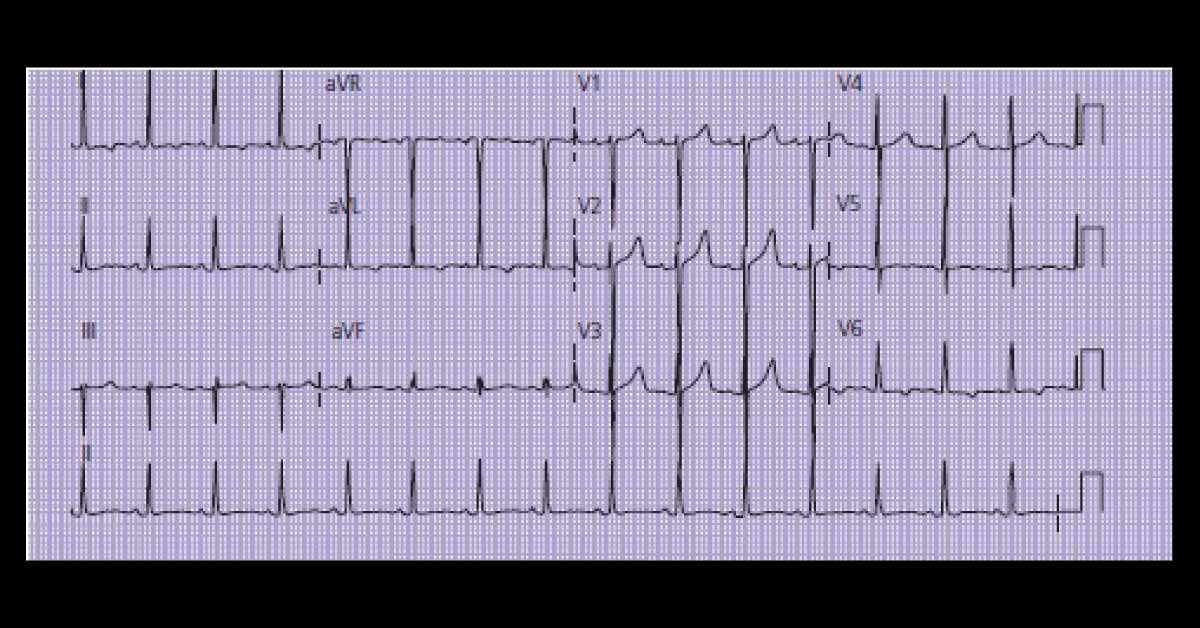 What Does The ECG Reveal?