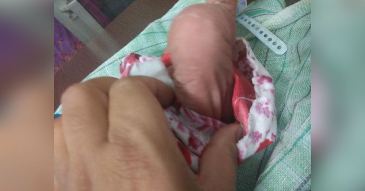 New Born With Loose Skin