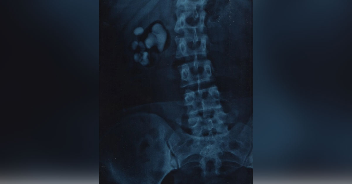 Identify This Urological Disorder