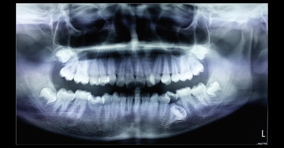 A Teenager with Irregular Teeth in the Oral Cavity