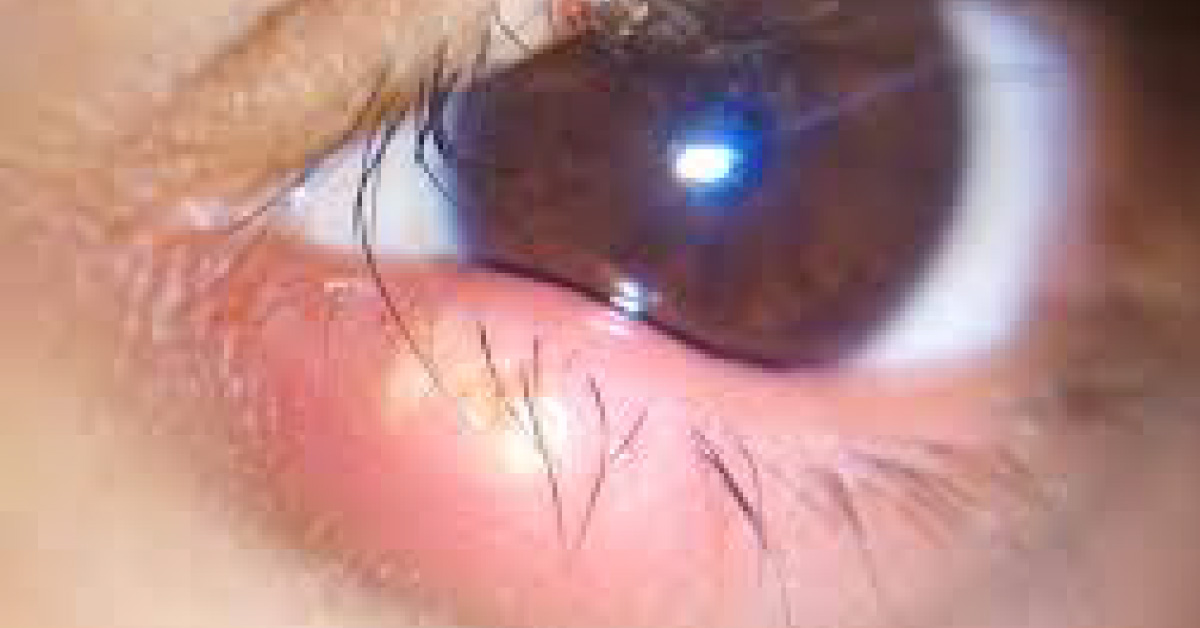 Overview On Madarosis