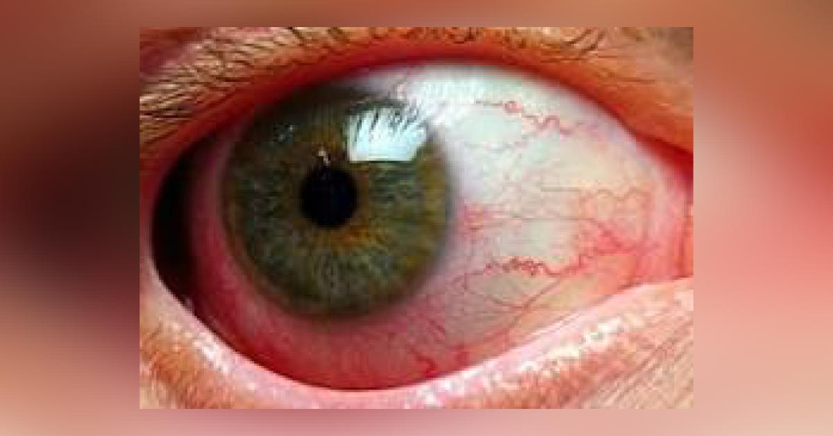 How To Proceed With Clinical Presentation Of Iridocyclitis