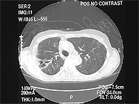 An Old Woman With Dyspnea