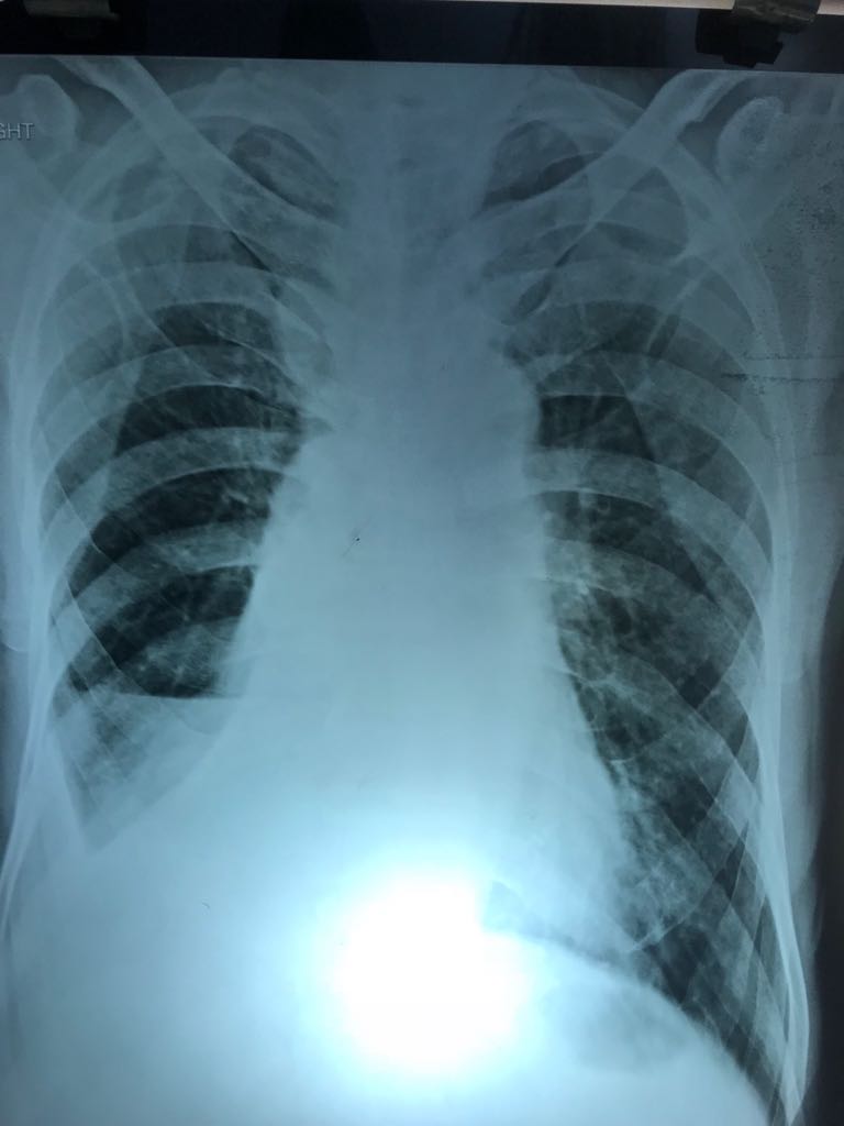 Is There Pleural Effusion Or Not? 