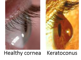 Present Status And Treatment Of Keratoconus