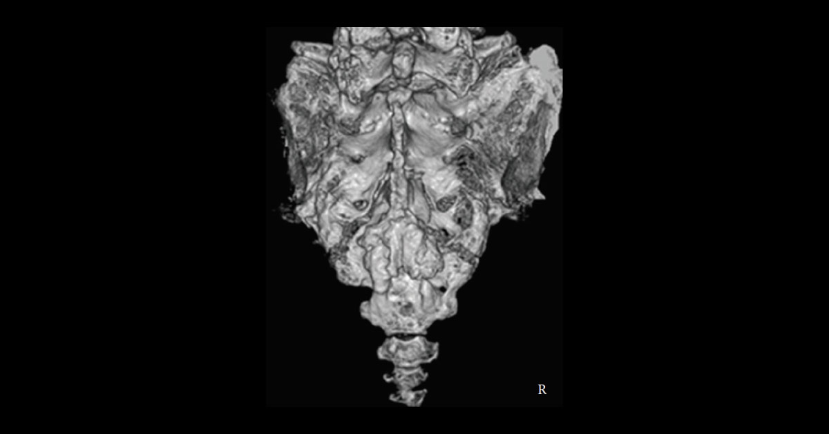 Case of Urinary Retention and Perineal Numbness