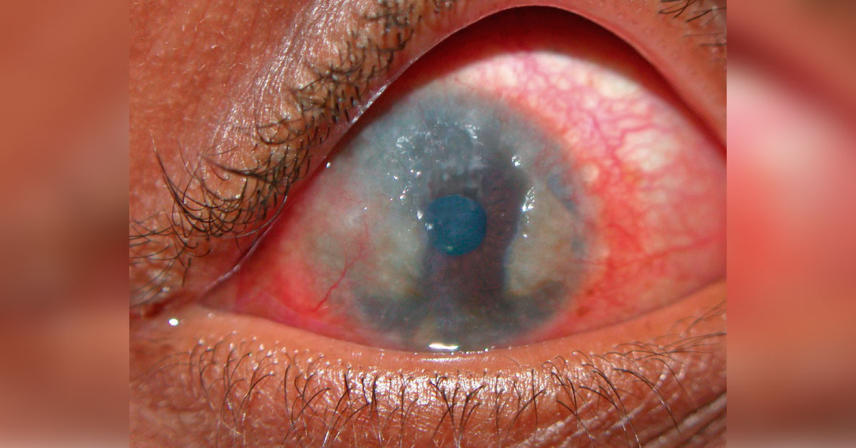 How To Proceed With The Treatment Of Vernal Keratoconjunctivitis?
