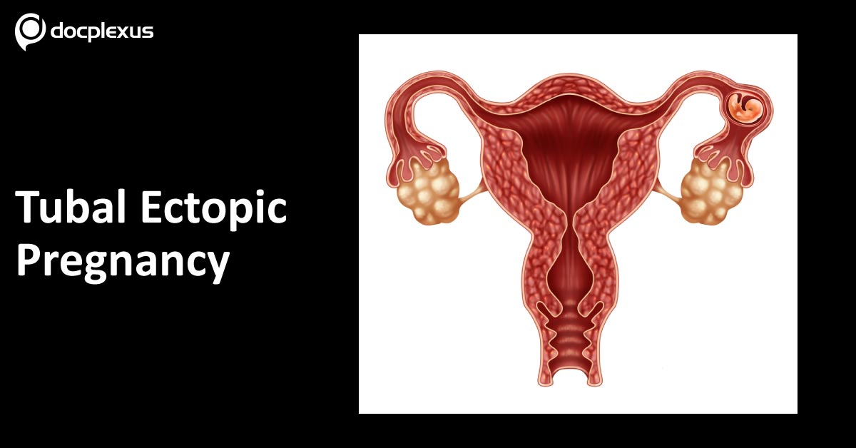 Tubal Ectopic Pregnancy: Guidelines by The American College of Obstetricians and Gynecologists