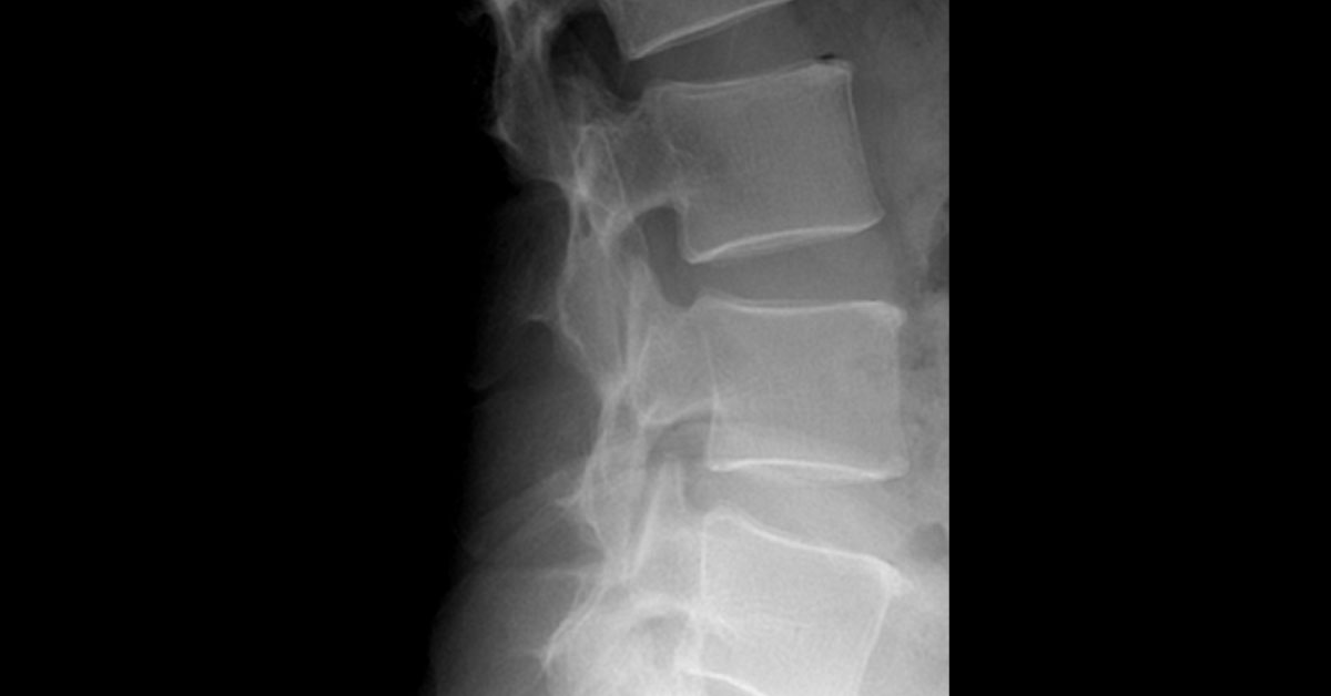 Construction Worker With Chronic Back Pain
