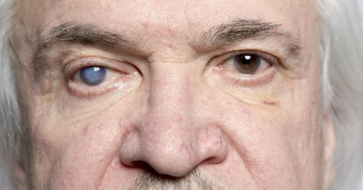 Are Glaucoma Incidences Increasing