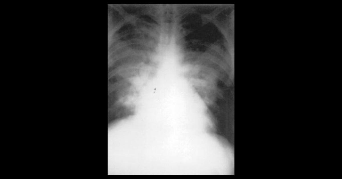 Woman Suffering From Shortness Of Breath