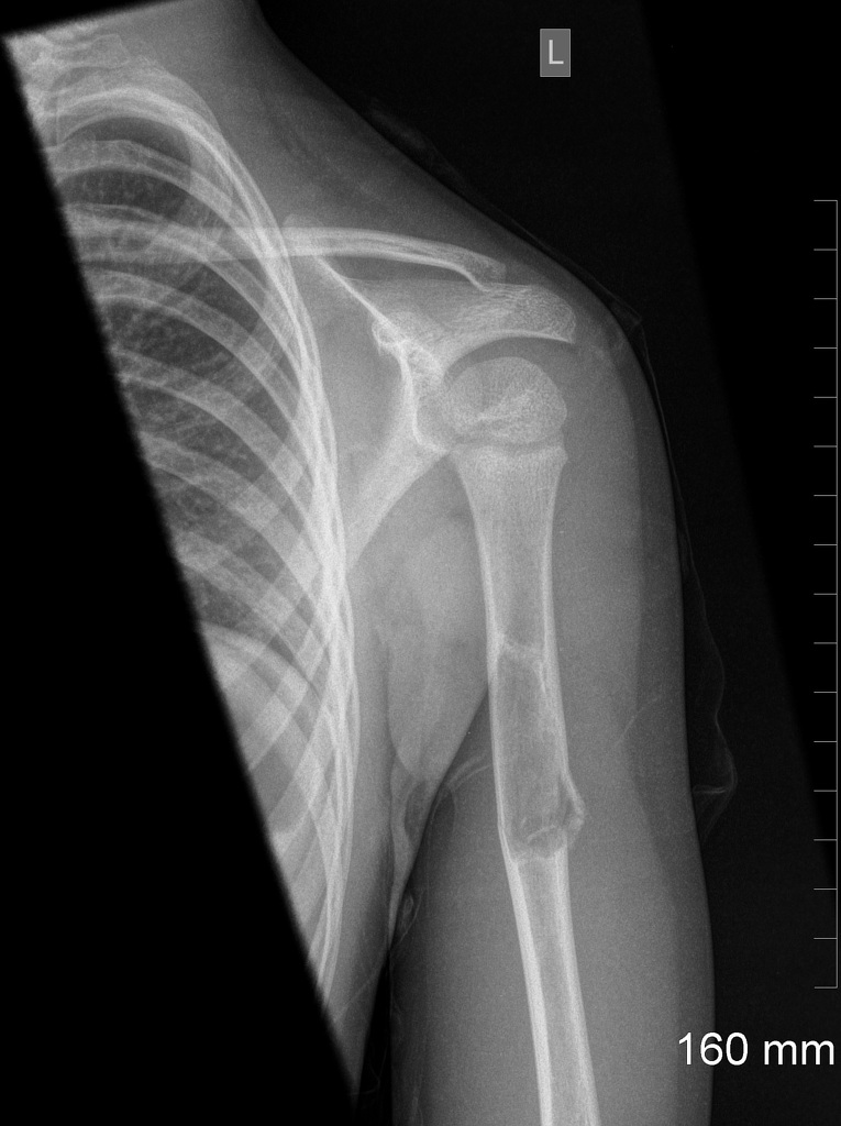 Girl with an Injured Humerus