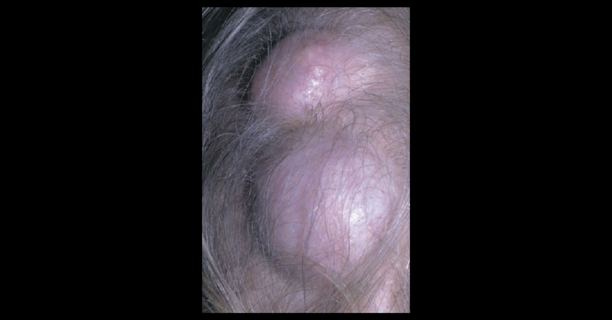 A Case Of Smooth Scalp Lumps