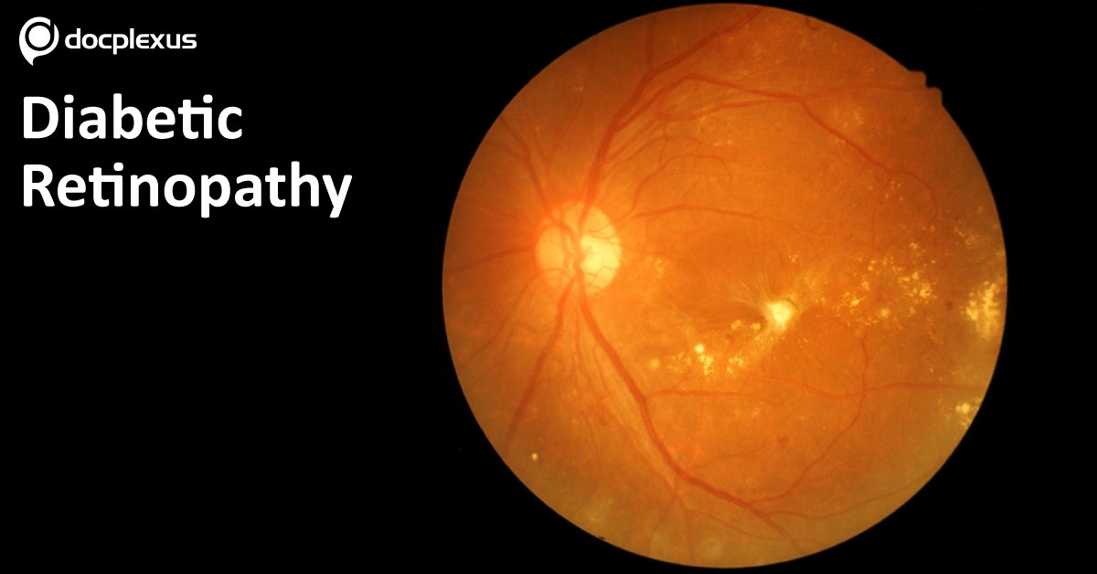 Diabetic Retinopathy And Long Chain Ceramides