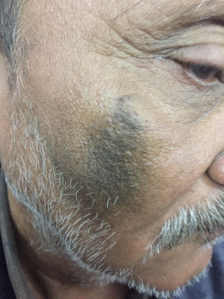 Diagnose The Black Papular Acne