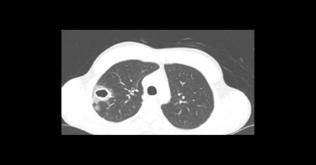 Can You Diagnose This Infection?
