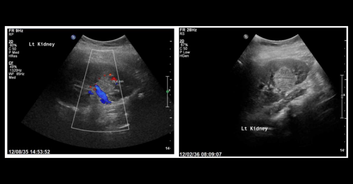 Girl with a Medical History of Recurrent UTIs