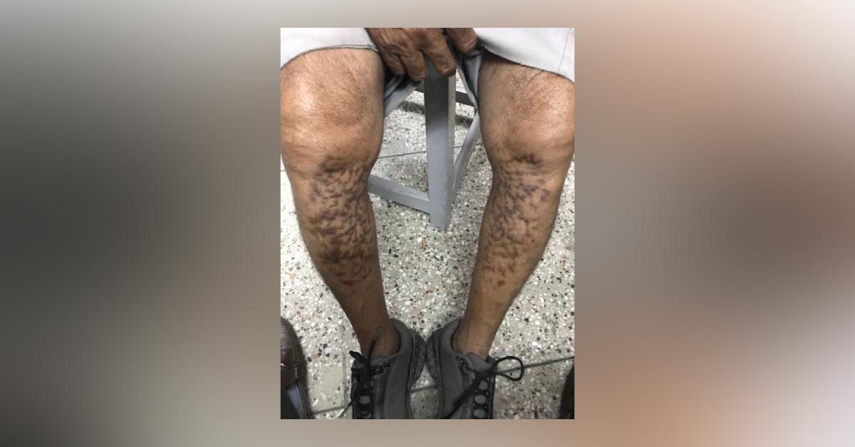 What Is This Skin Lesions? 