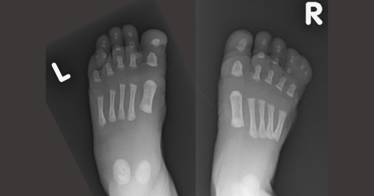 An Infant with Webbed Toes - What's Your Diagnosis?