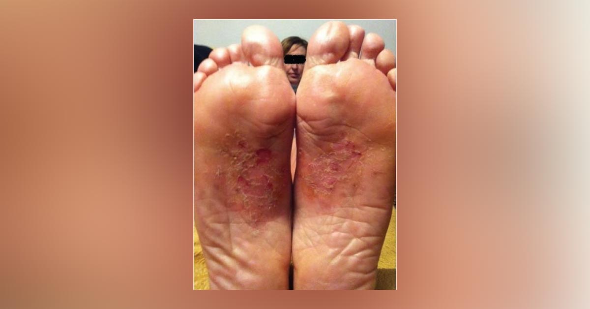 Case of a Woman with Recurrent Dermatitis
