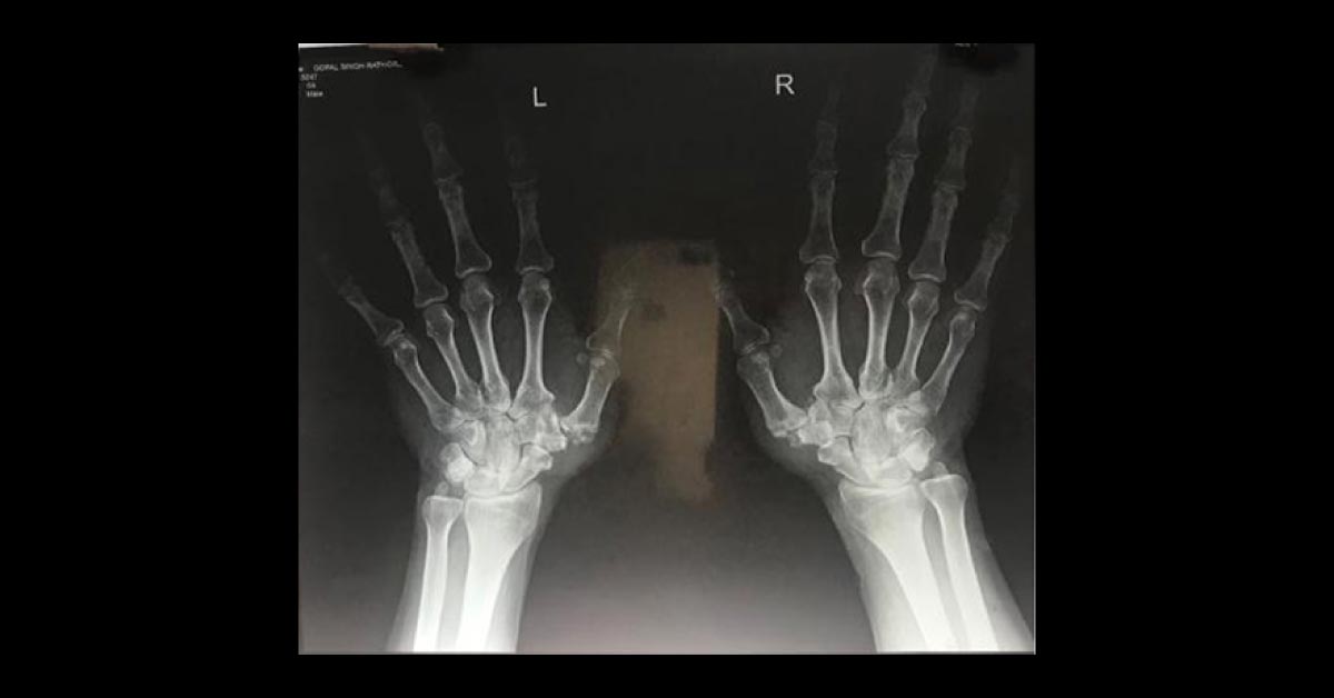 Diagnose The Pain In 1st MCP Joints