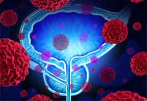 Embolization Of Prostatic Arteries For Benign Prostatic Hyperplasia