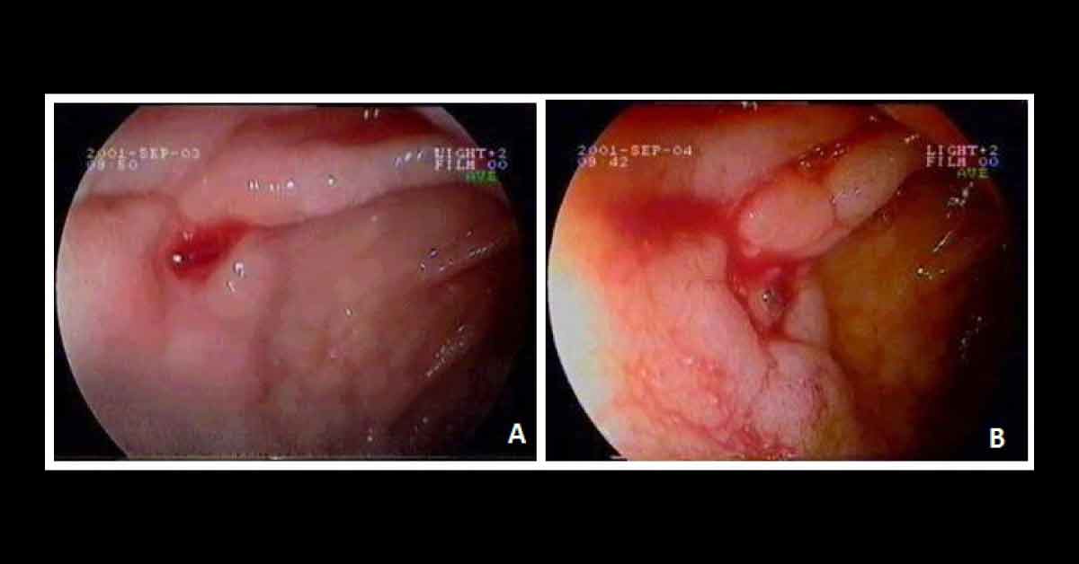 Man With Hematemesis: What Is Your Diagnosis?