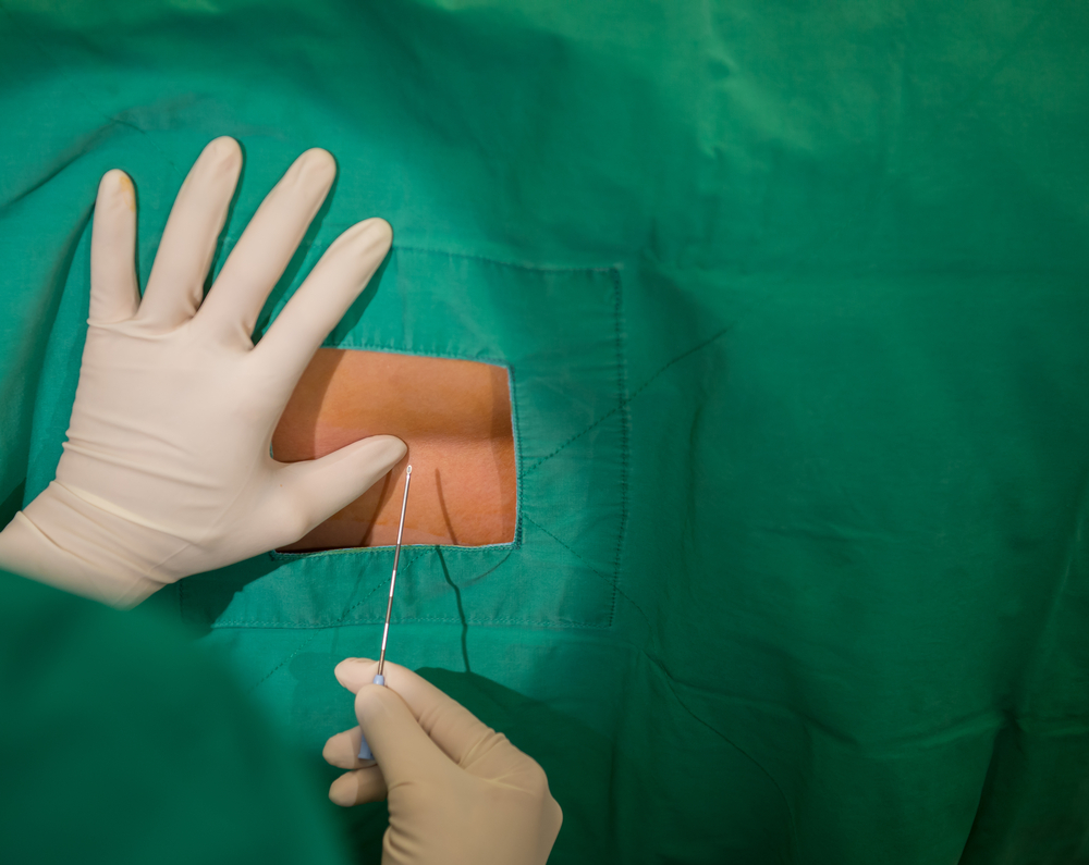 Spine Surgeries Under Spinal Anesthesia With Dexmedetomidine Intrathecal & Bupivacaine Heavy, A New Horizon