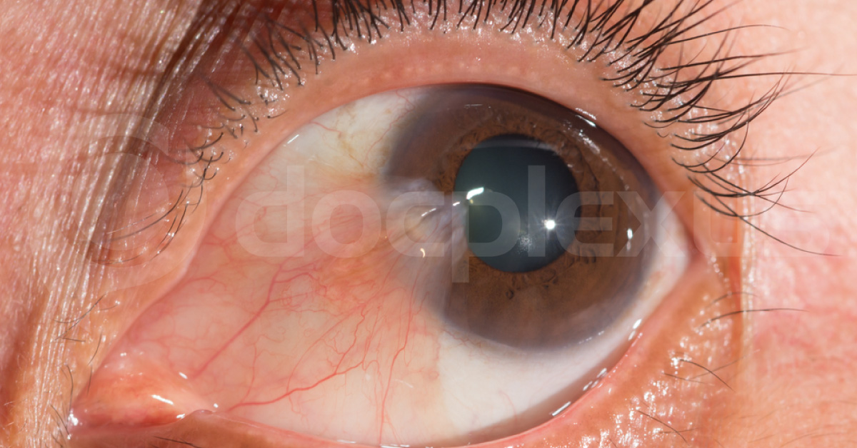 Brief Review On Management Of Recurrent Pterygium