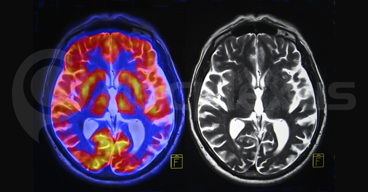 New PET Scan Imaging Agent Identified To Diagnose & Treat Brain Diseases
