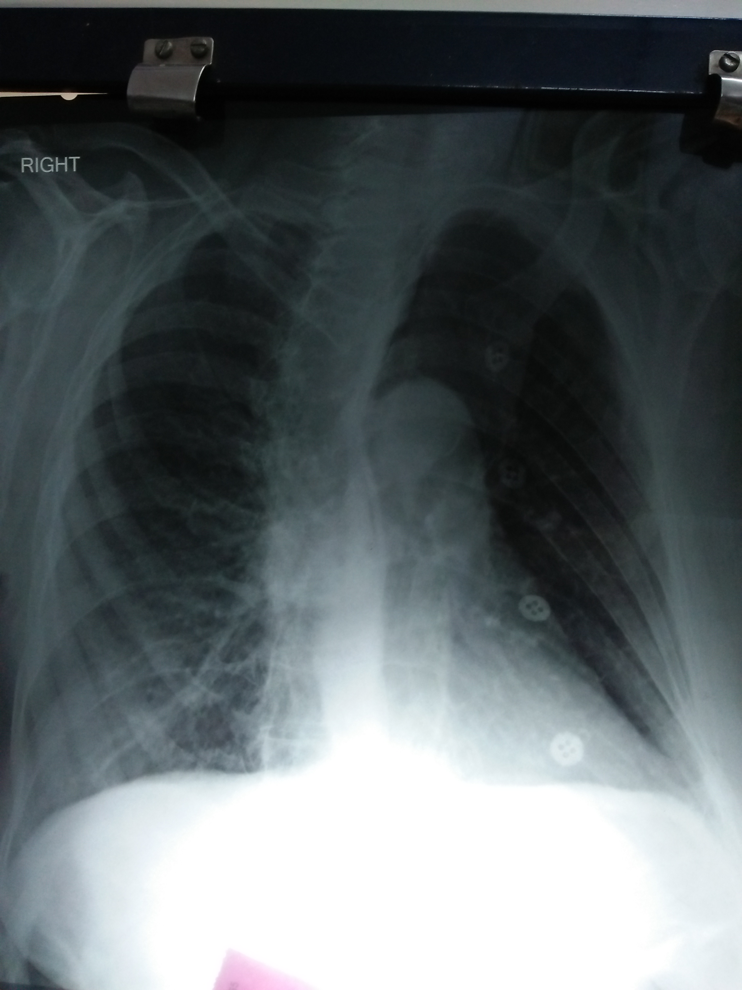 What Happened To Vertebrae In This X Ray Chest?