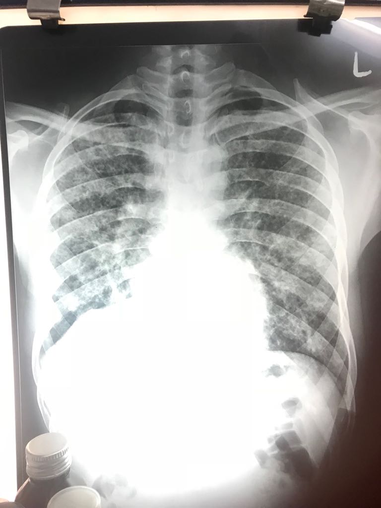 Suggest Line Of Treatment For Pneumoconiosis?