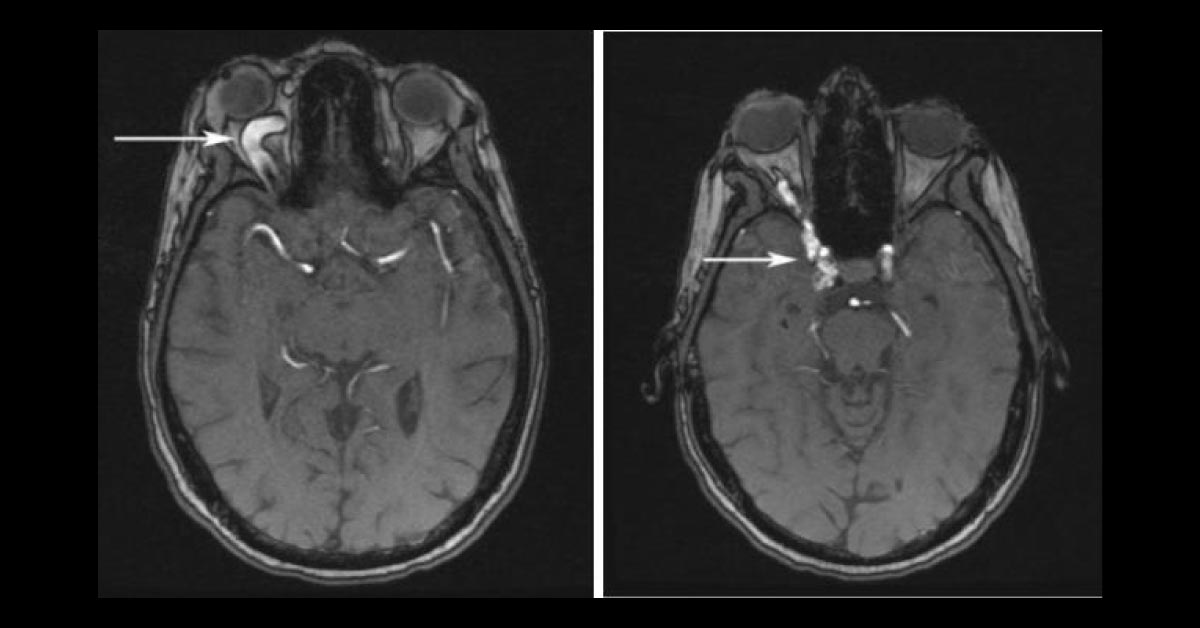 Double Vision Following a Bicycle Accident