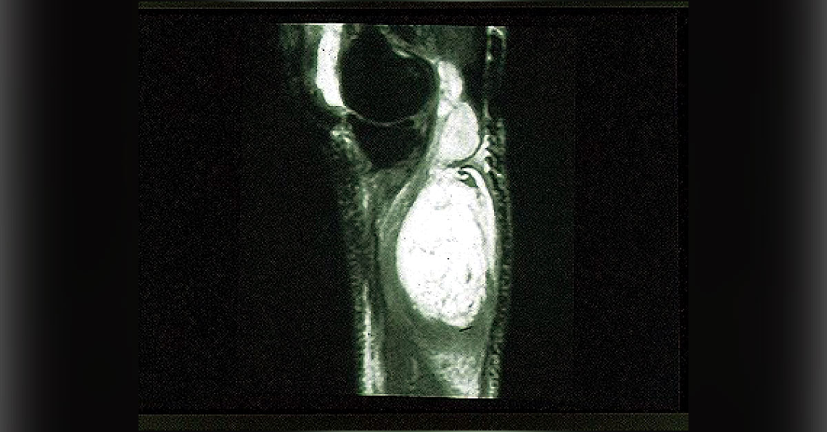 Case of a Female with Knee Pain and Swelling Following a Bacterial Infection