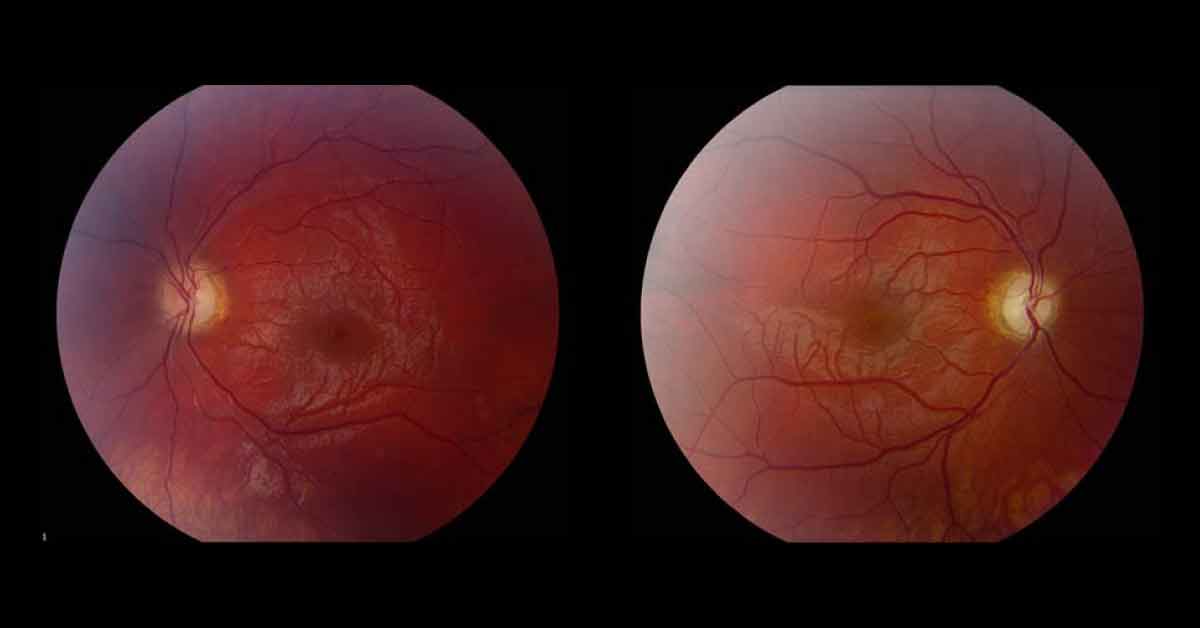 Identify This Rare Hereditary Ophthalmic Condition