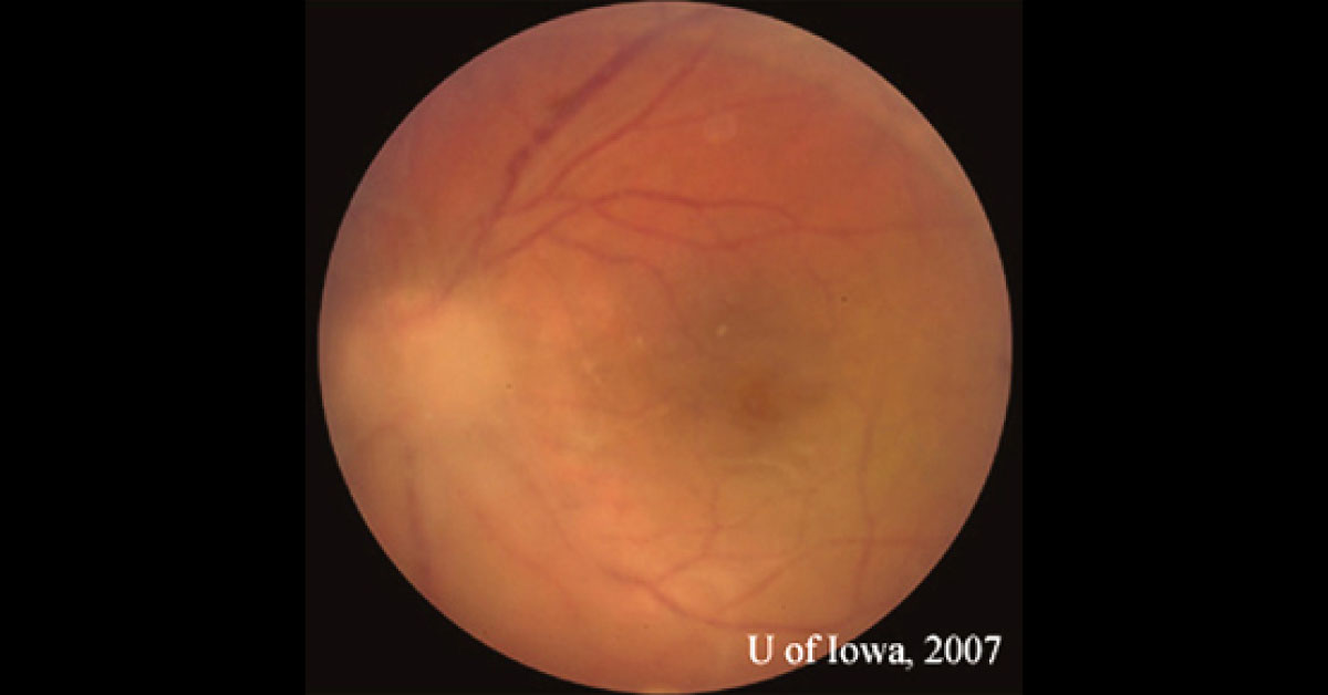 Case of a Female with Fuzzy Vision