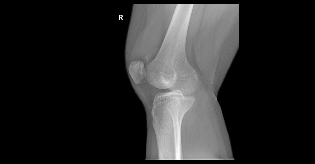 A Female with Knee Joint Pain