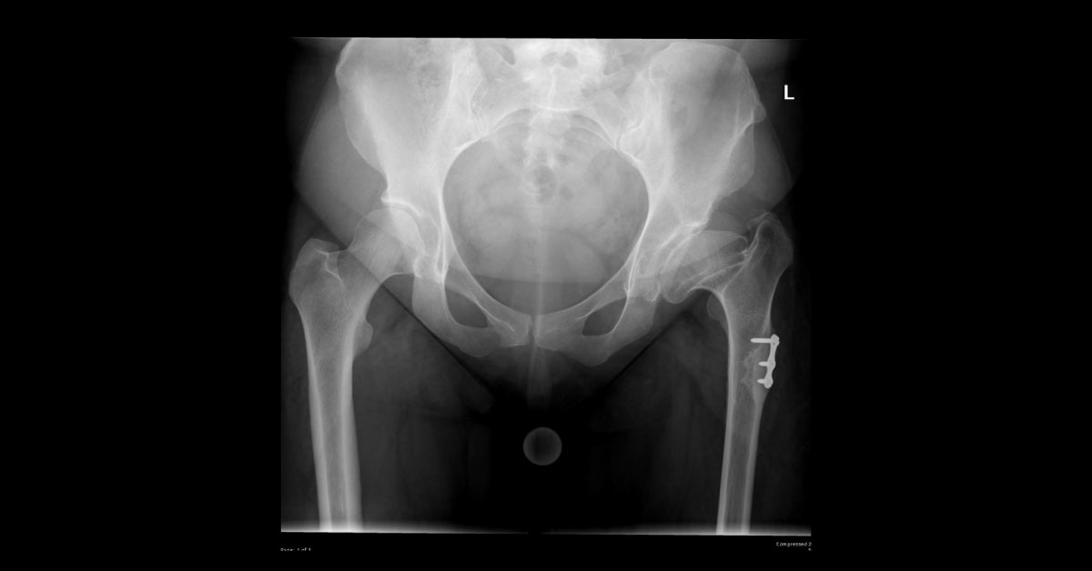 Left Sided Limp In A Patient