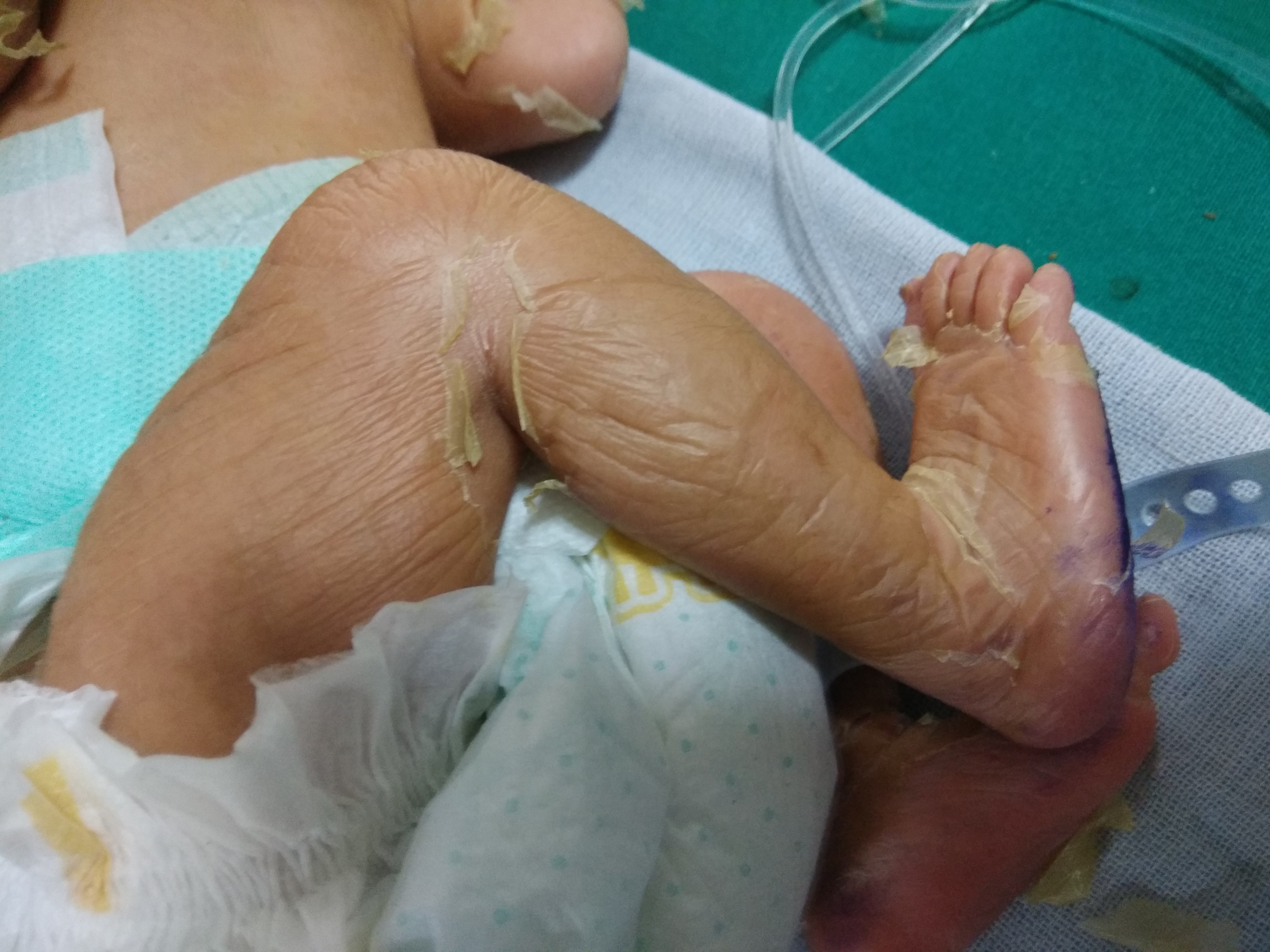 What Is Cause Of Parchment Like Skin In Full-Term Newborn?