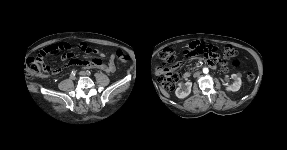 A Male with Painless Hematuria