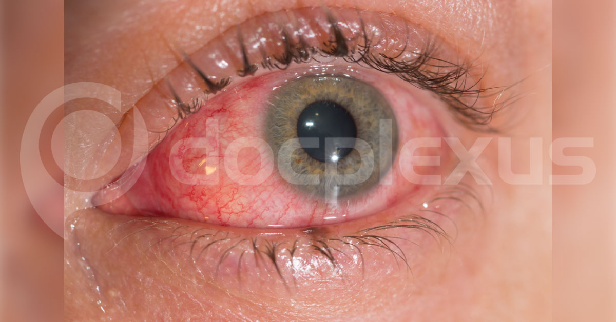 How To Proceed With Conjunctivitis?