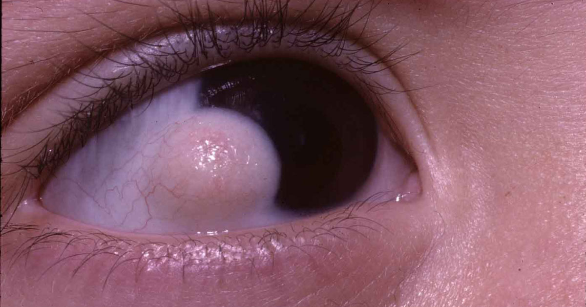 Surgical Modalities Of Congenital Limbal Dermoids
