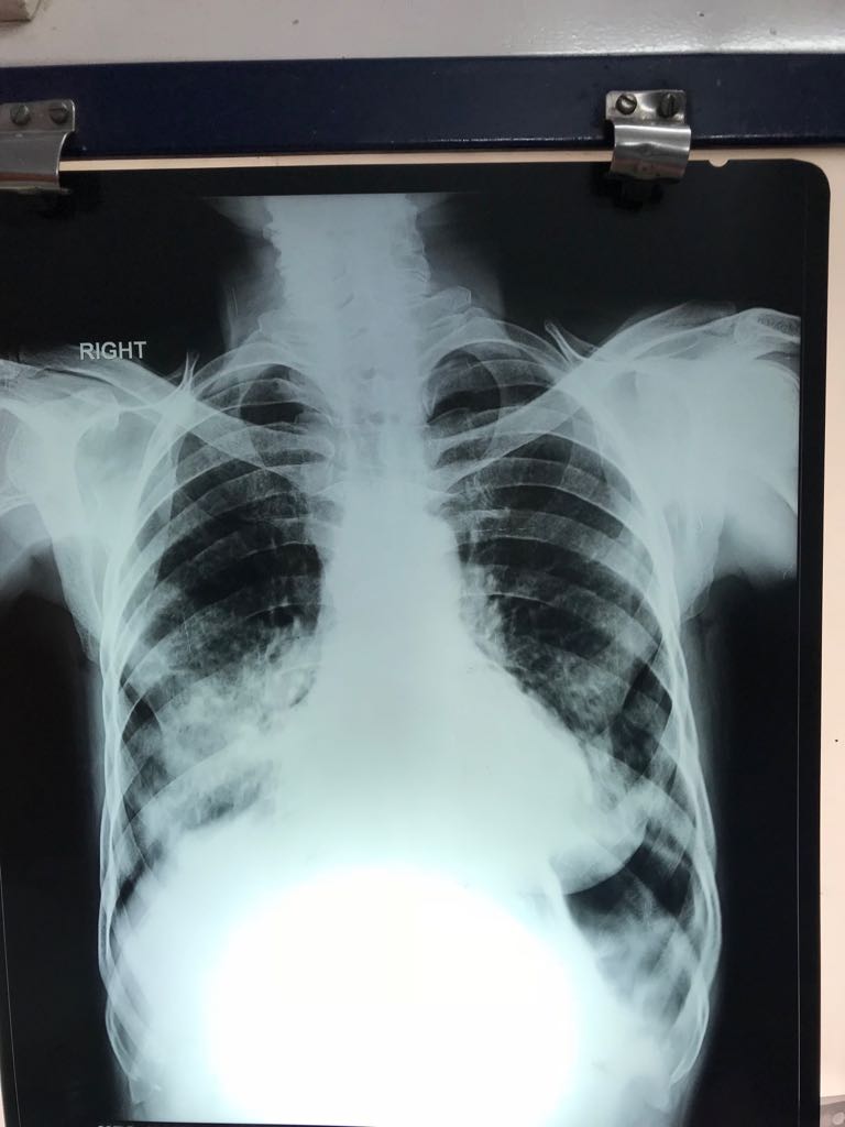 Is There Pneumothorax On Left Side Or Not?