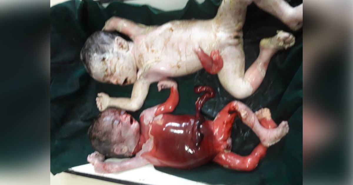 What Had Caused Intrauterine Death Of The Twins?