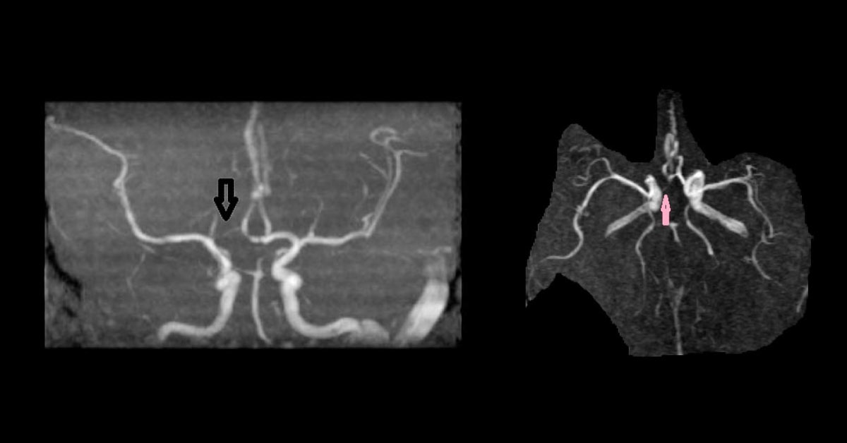 Spot This Neurologic Condition