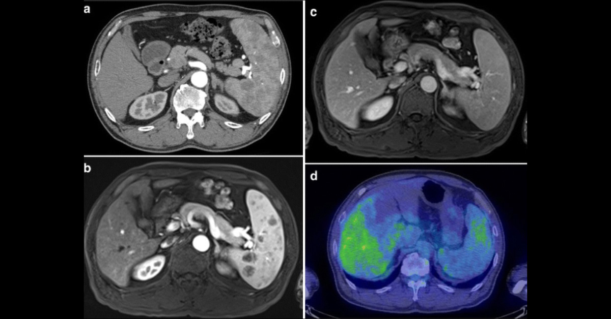 Man with Multiple Splenic Masses