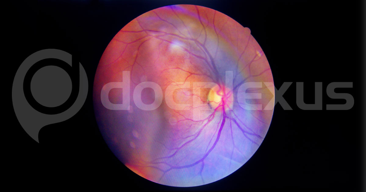 Novel Technology Detecting Diabetic Retinopathy