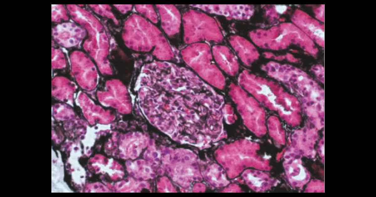 A Sickle Cell Trait Male With Abdominal Pain