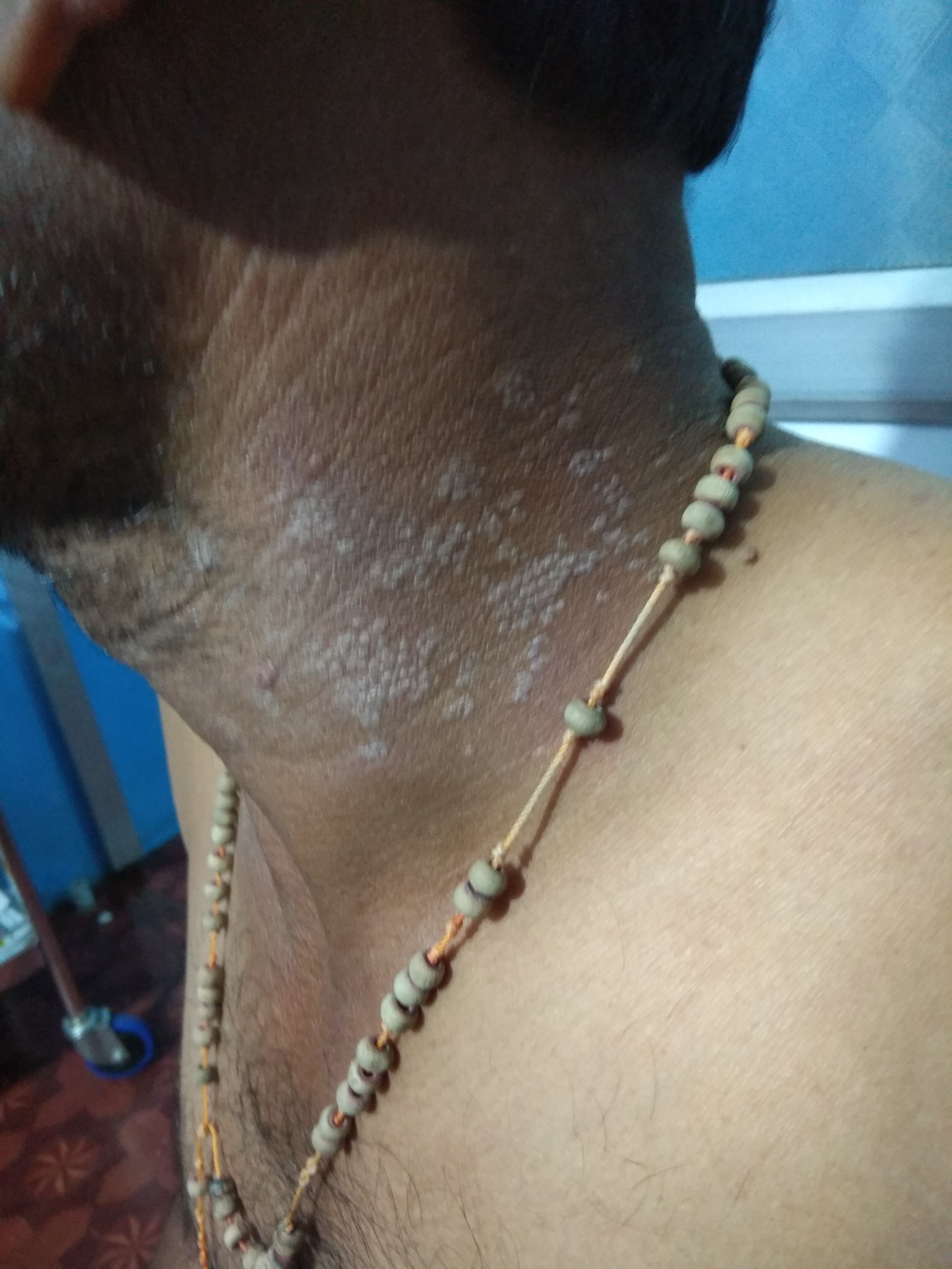 Diagnose These Scaly Lesions On Neck