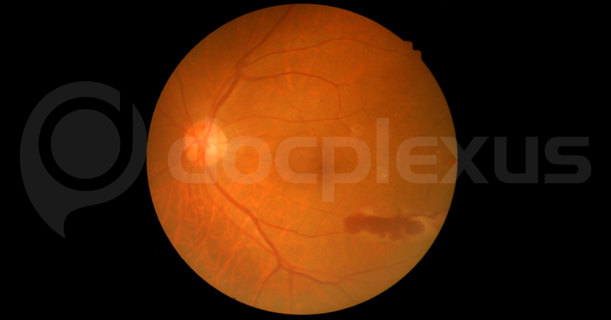 Recurrent Vitreous Hemorrhage Due To Hypertension
